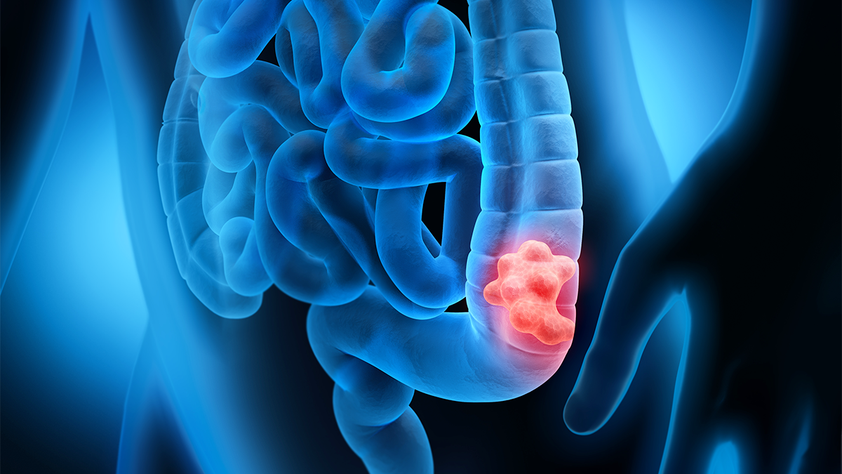 An illustration of colon cancer inside the large instestine